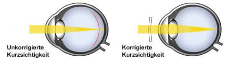 kurzsichtigkeit.jpg